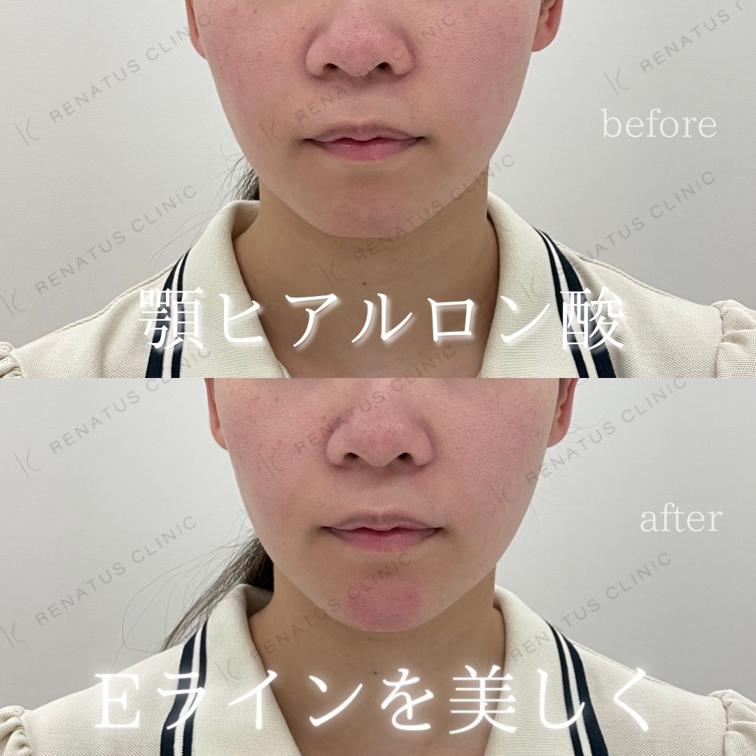 顎ヒアルロン酸ボラックス症例写真 顎ヒアルロン酸ボラックス症例写真