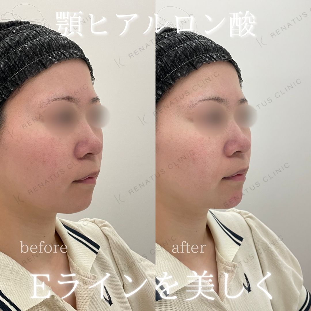顎ヒアルロン酸ボラックス症例写真 顎ヒアルロン酸ボラックス症例写真