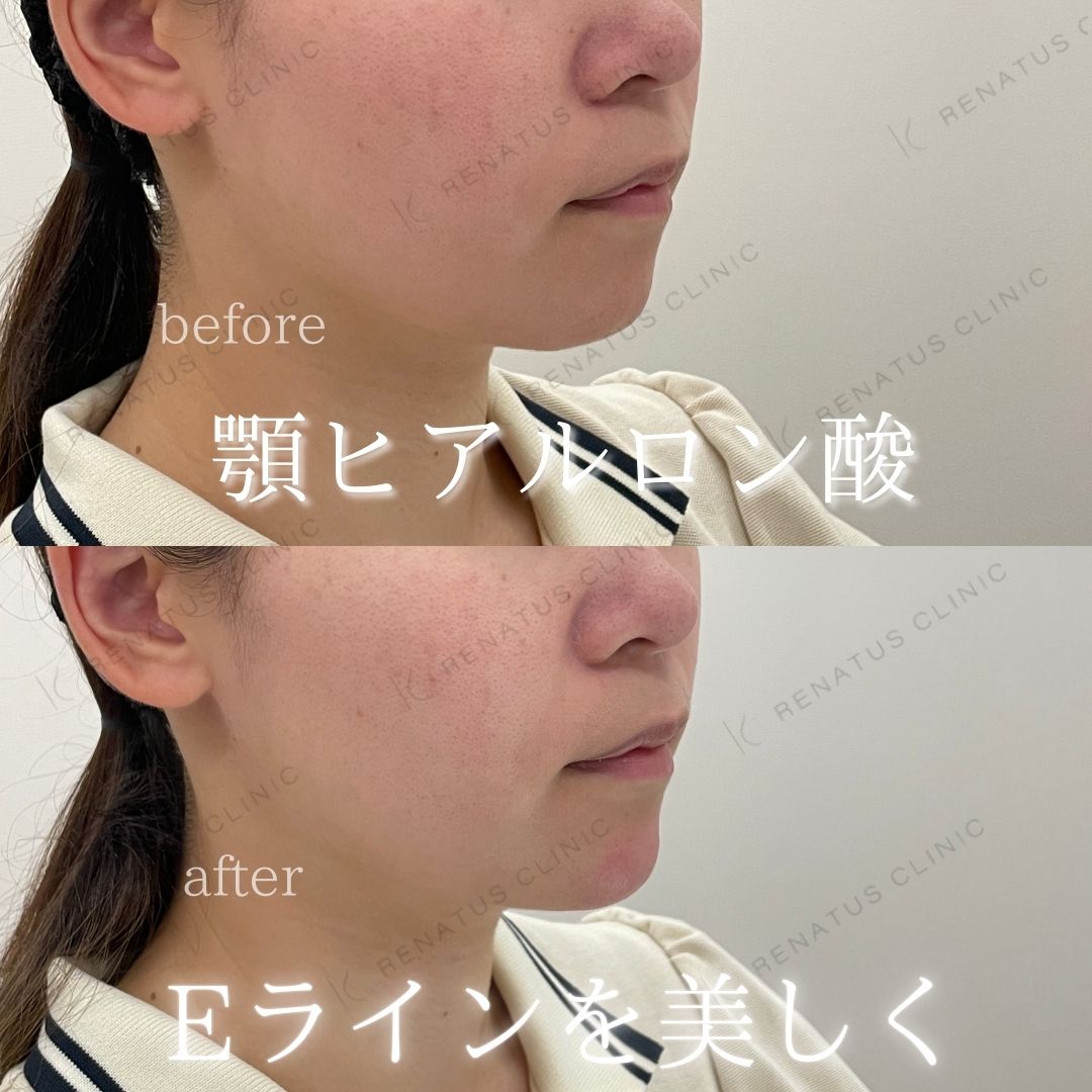顎ヒアルロン酸ボラックス症例写真