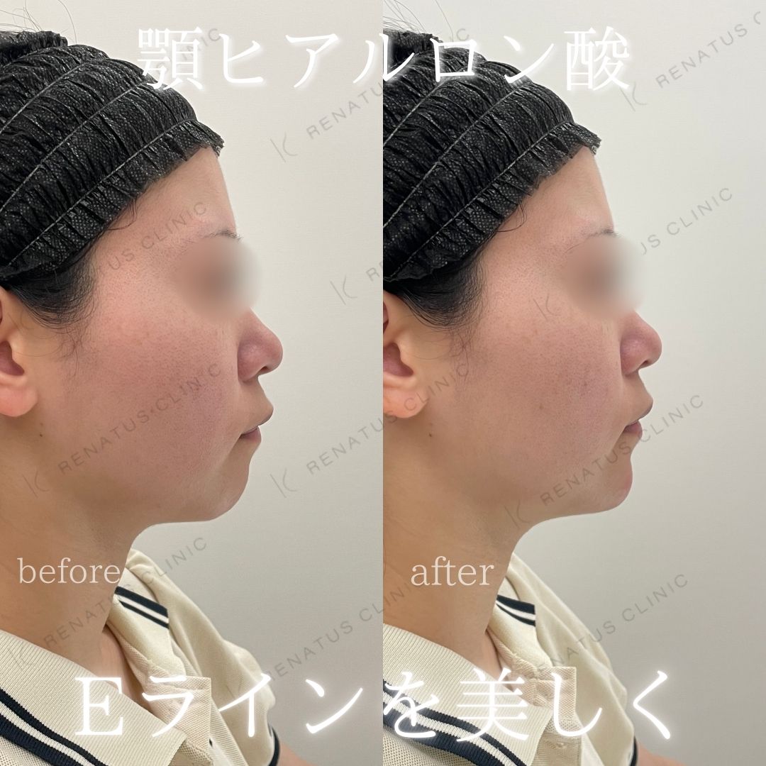 顎ヒアルロン酸ボラックス症例写真 顎ヒアルロン酸ボラックス症例写真