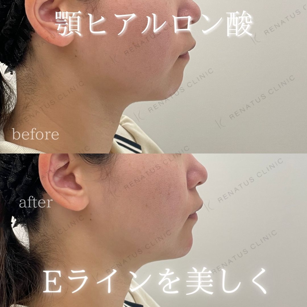 顎ヒアルロン酸ボラックス症例写真 顎ヒアルロン酸ボラックス症例写真
