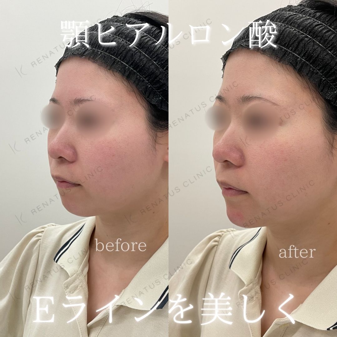 顎ヒアルロン酸ボラックス症例写真 顎ヒアルロン酸ボラックス症例写真