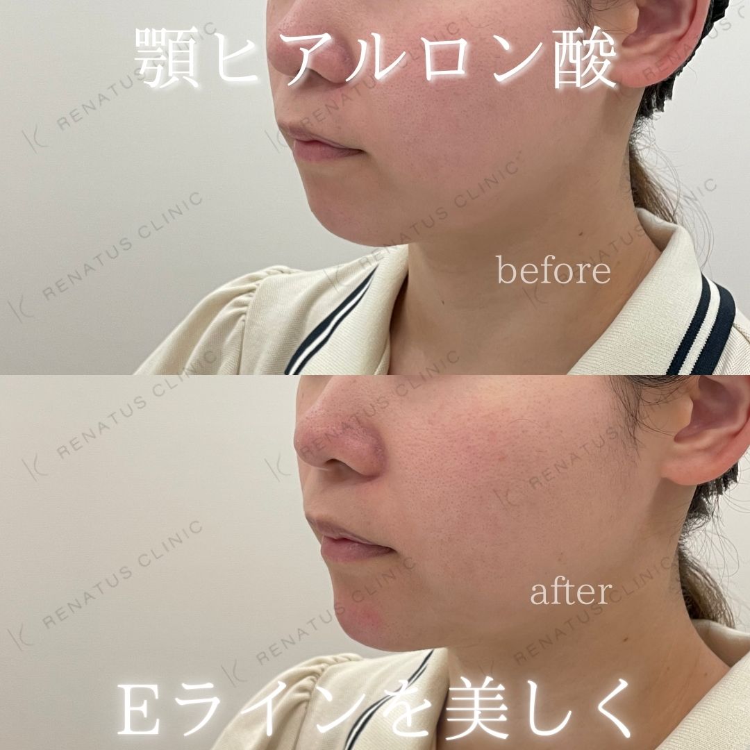 顎ヒアルロン酸ボラックス症例写真 顎ヒアルロン酸ボラックス症例写真