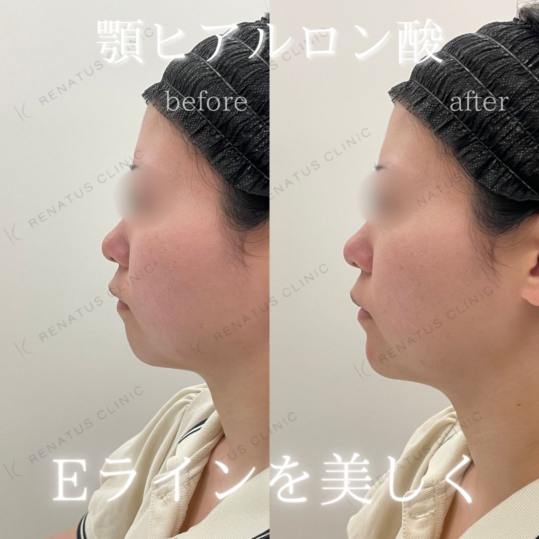 顎ヒアルロン酸ボラックス症例写真 顎ヒアルロン酸ボラックス症例写真