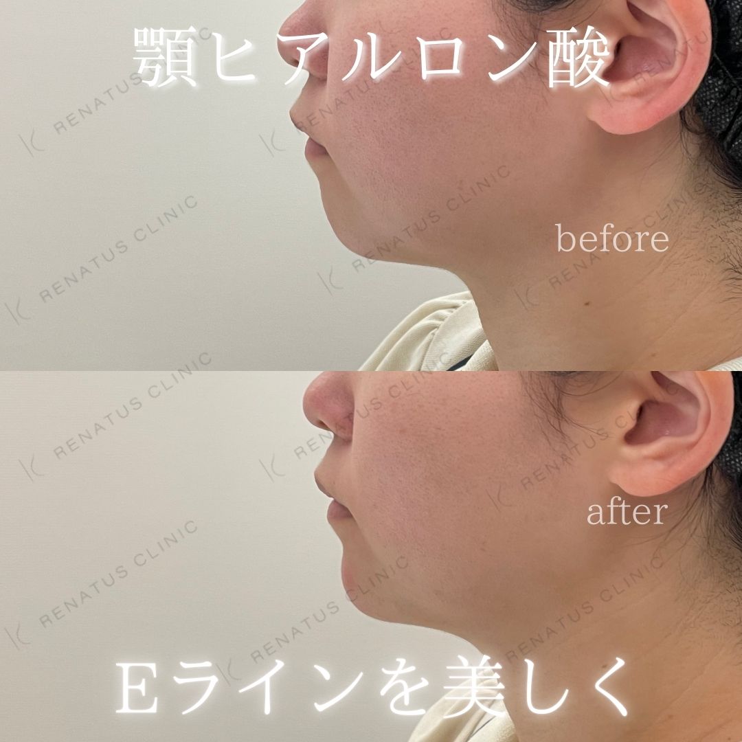顎ヒアルロン酸ボラックス症例写真 顎ヒアルロン酸ボラックス症例写真