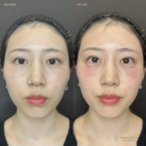 大阪梅田の涙袋ヒアルロン酸｜ボルベラの効果・料金相場【20代女性】の症例写真