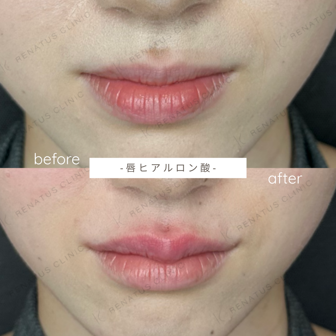 唇ヒアルロン酸ボルベラ症例写真 唇ヒアルロン酸ボルベラ症例写真