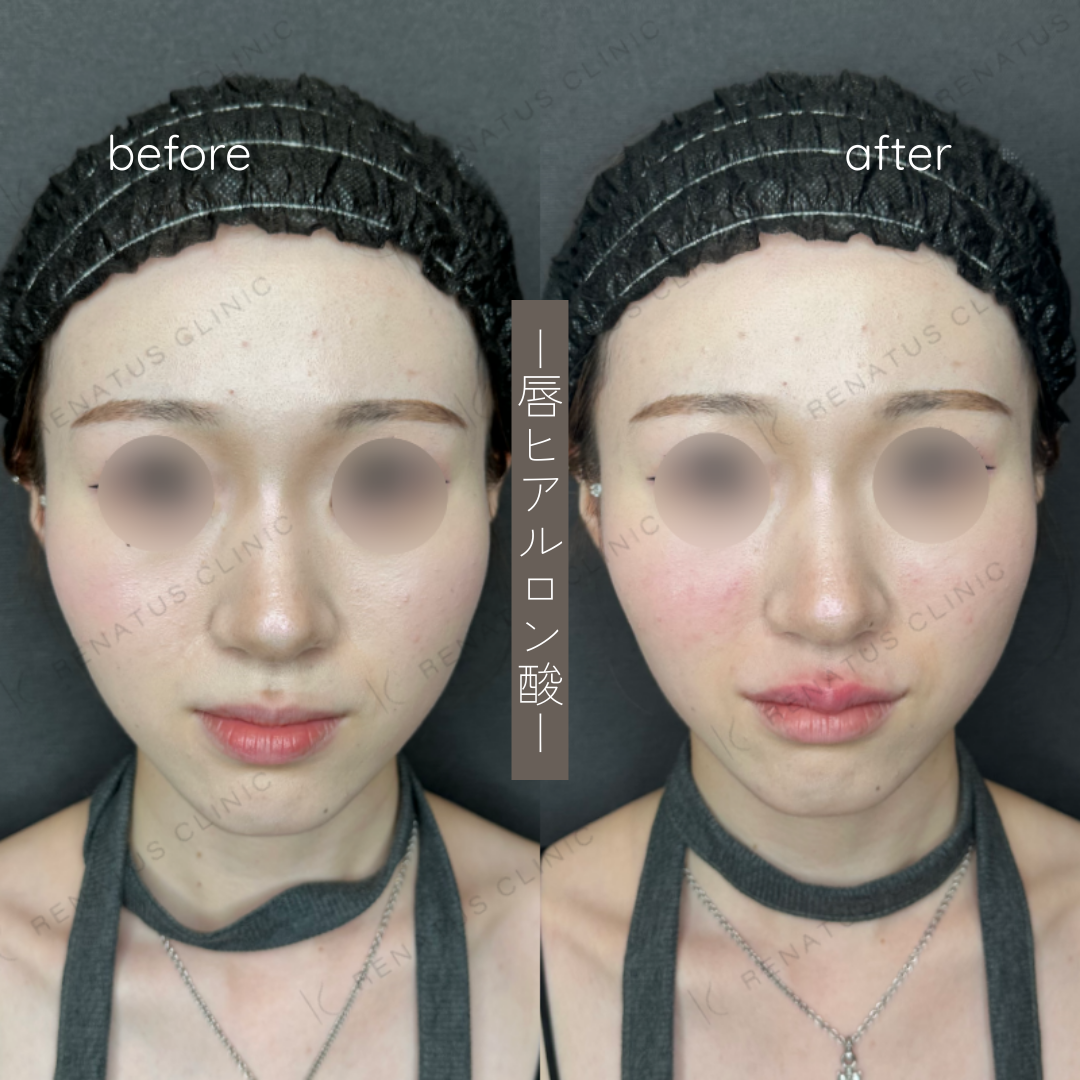 唇ヒアルロン酸ボルベラ症例写真 唇ヒアルロン酸ボルベラ症例写真