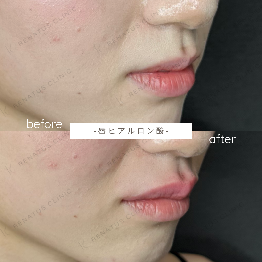 唇ヒアルロン酸ボルベラ症例写真 唇ヒアルロン酸ボルベラ症例写真