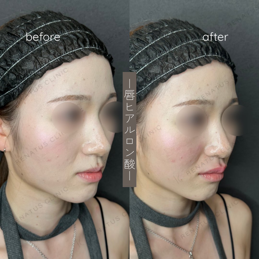 唇ヒアルロン酸ボルベラ症例写真 唇ヒアルロン酸ボルベラ症例写真