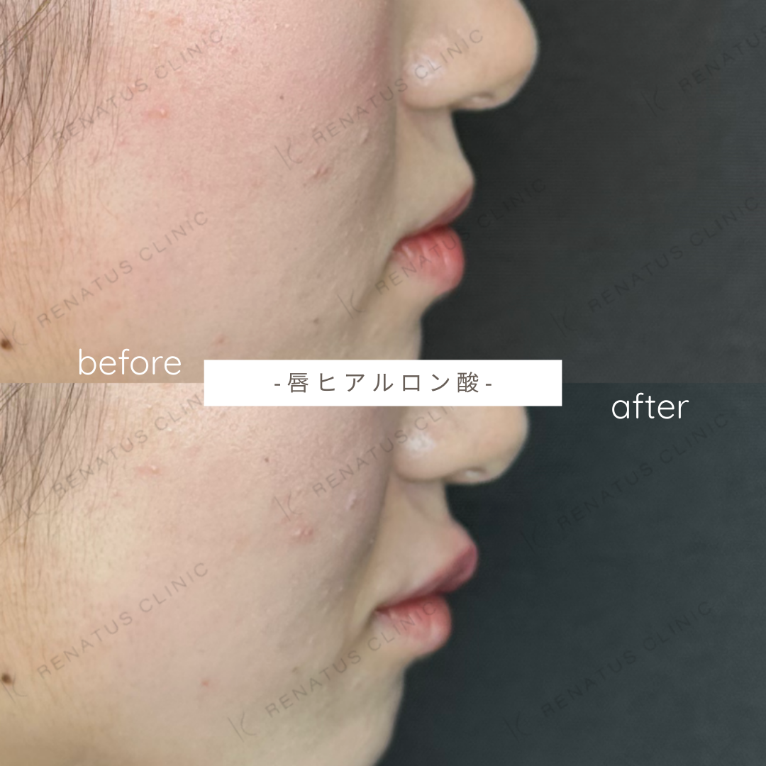 唇ヒアルロン酸ボルベラ症例写真 唇ヒアルロン酸ボルベラ症例写真