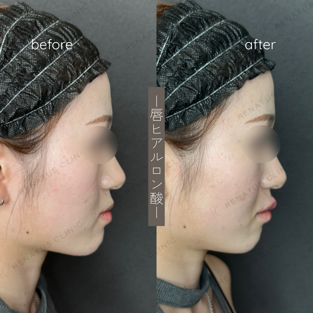 唇ヒアルロン酸ボルベラ症例写真 唇ヒアルロン酸ボルベラ症例写真