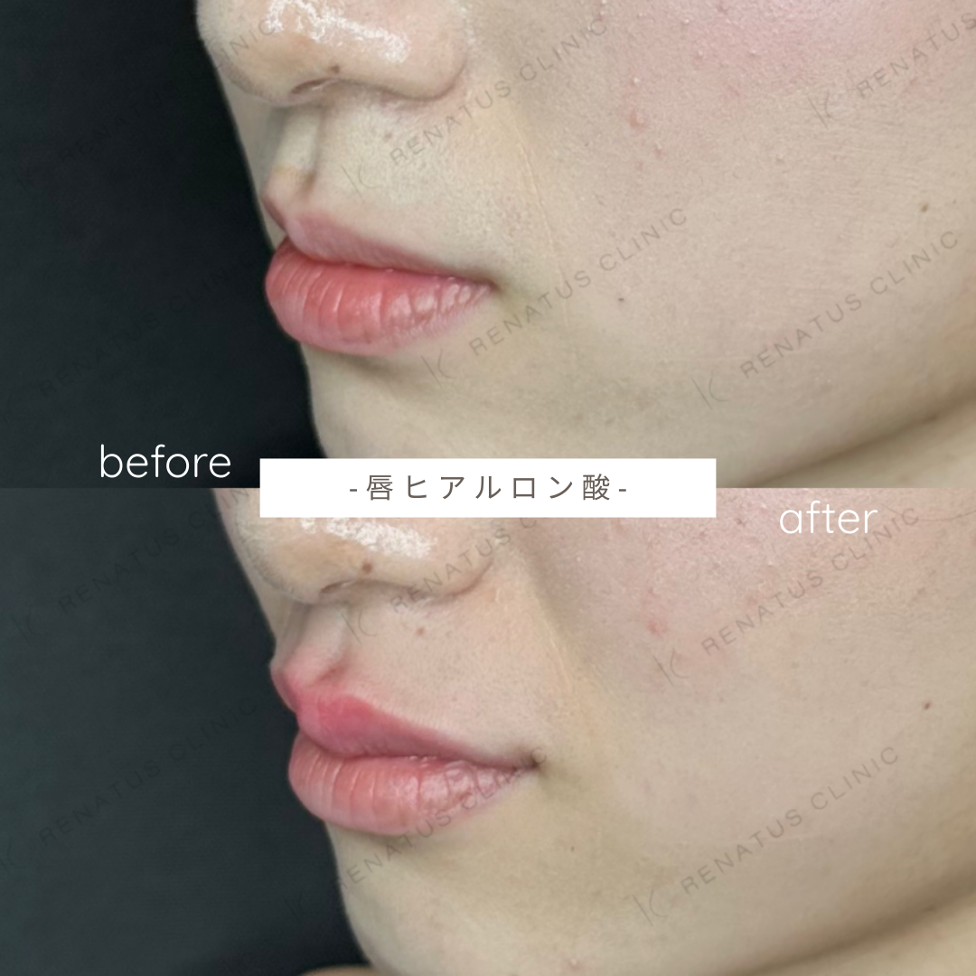 唇ヒアルロン酸ボルベラ症例写真 唇ヒアルロン酸ボルベラ症例写真