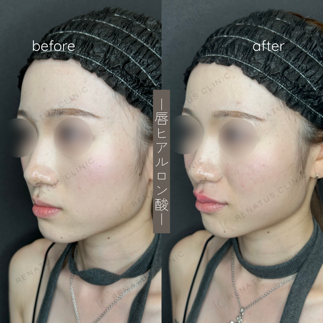 唇ヒアルロン酸ボルベラ症例写真 唇ヒアルロン酸ボルベラ症例写真