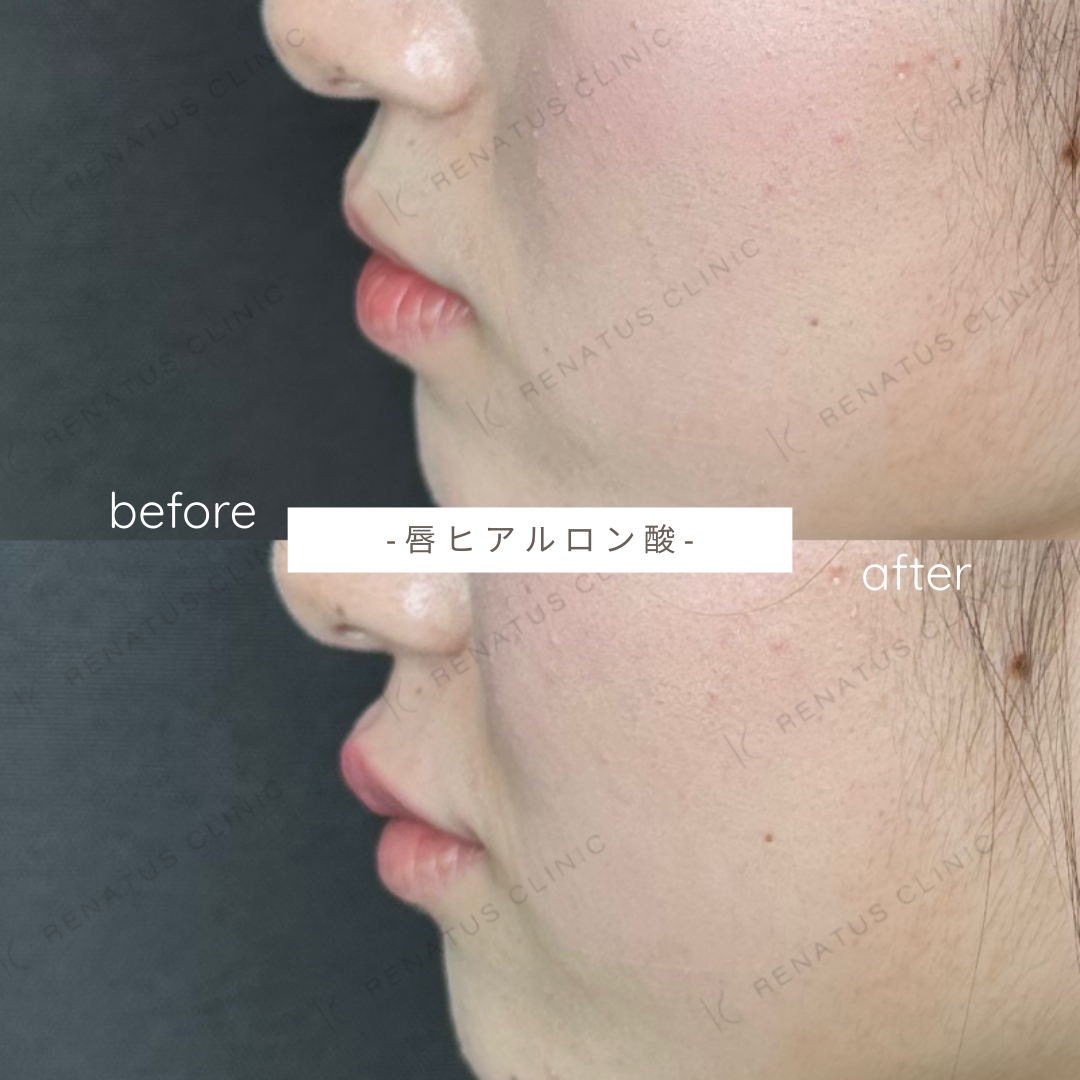 唇ヒアルロン酸ボルベラ症例写真 唇ヒアルロン酸ボルベラ症例写真