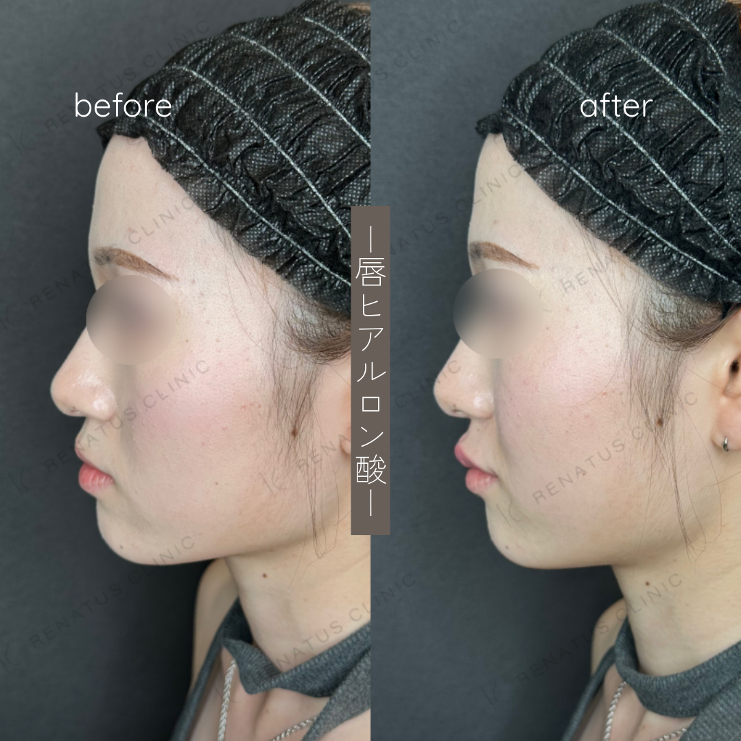 唇ヒアルロン酸ボルベラ症例写真 唇ヒアルロン酸ボルベラ症例写真