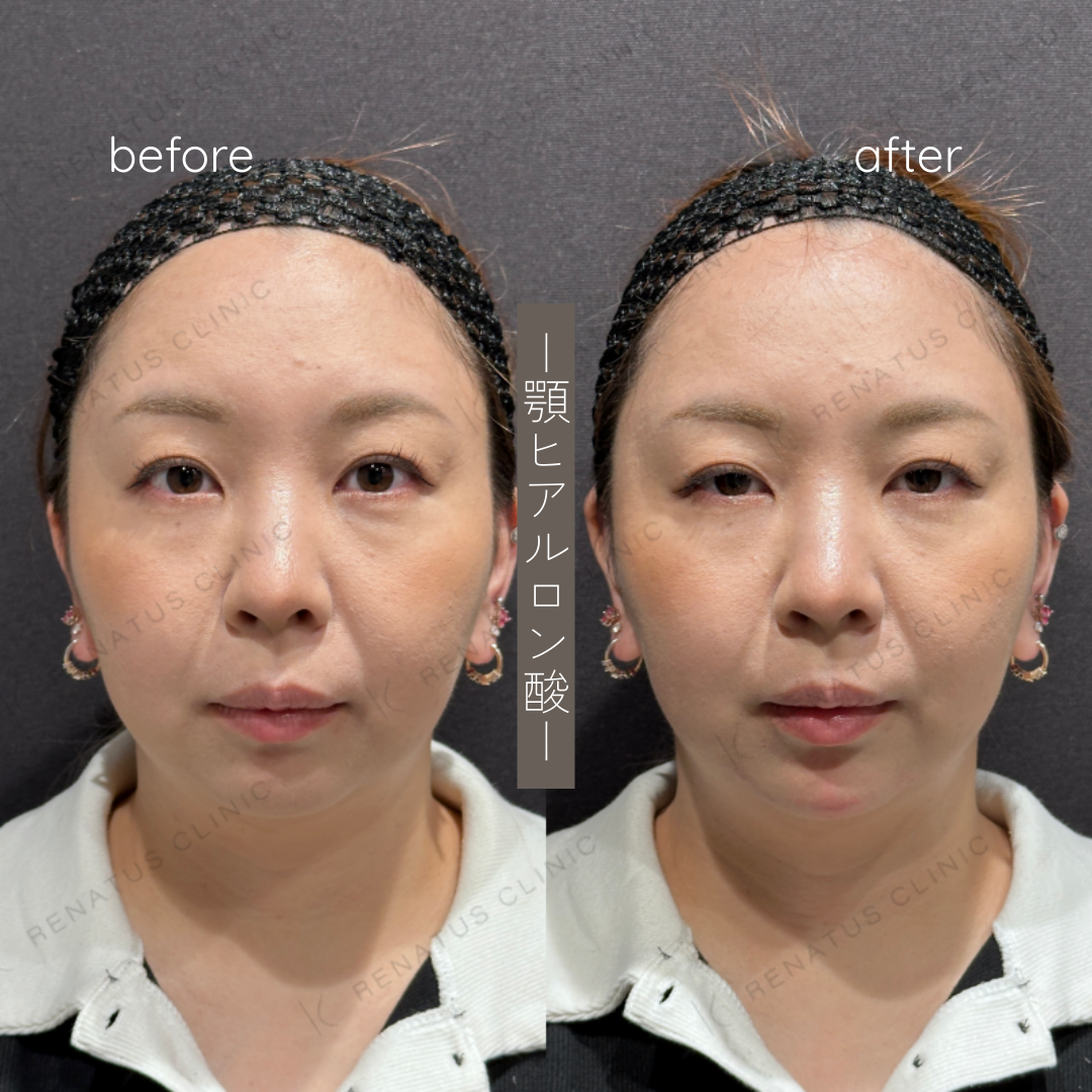 顎ヒアルロン酸ボラックス症例写真 顎ヒアルロン酸ボラックス症例写真