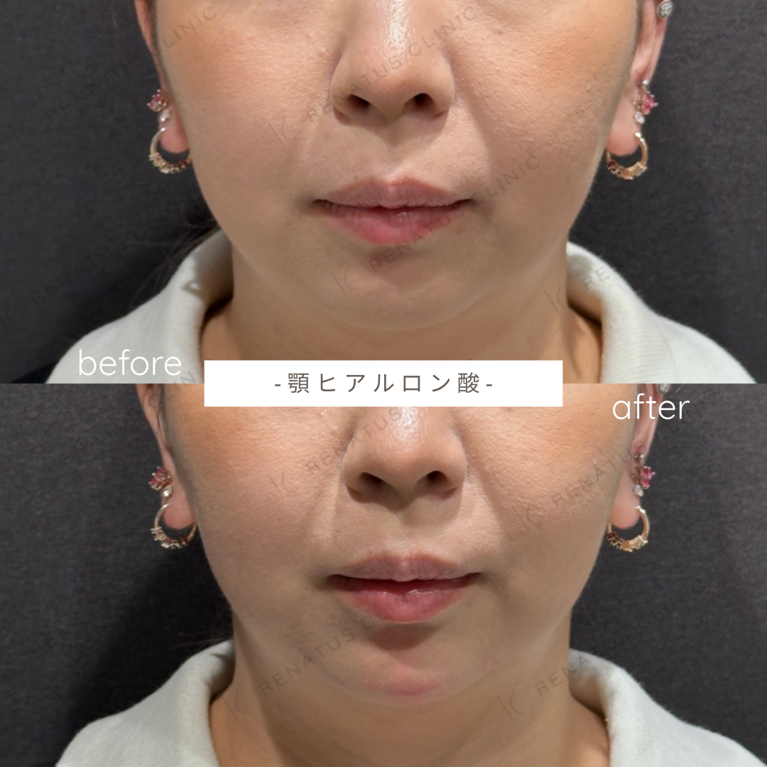 顎ヒアルロン酸ボラックス症例写真 顎ヒアルロン酸ボラックス症例写真