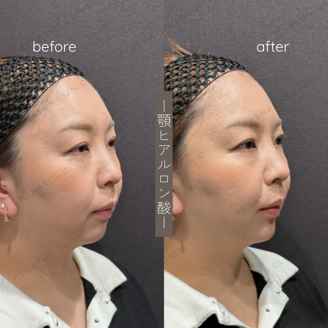 顎ヒアルロン酸ボラックス症例写真 顎ヒアルロン酸ボラックス症例写真