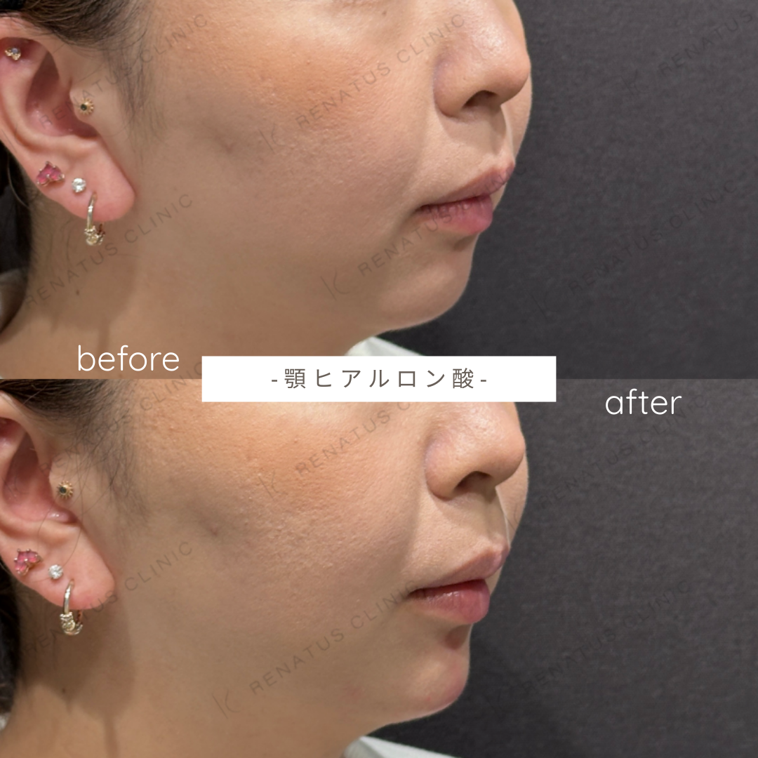 顎ヒアルロン酸ボラックス症例写真 顎ヒアルロン酸ボラックス症例写真
