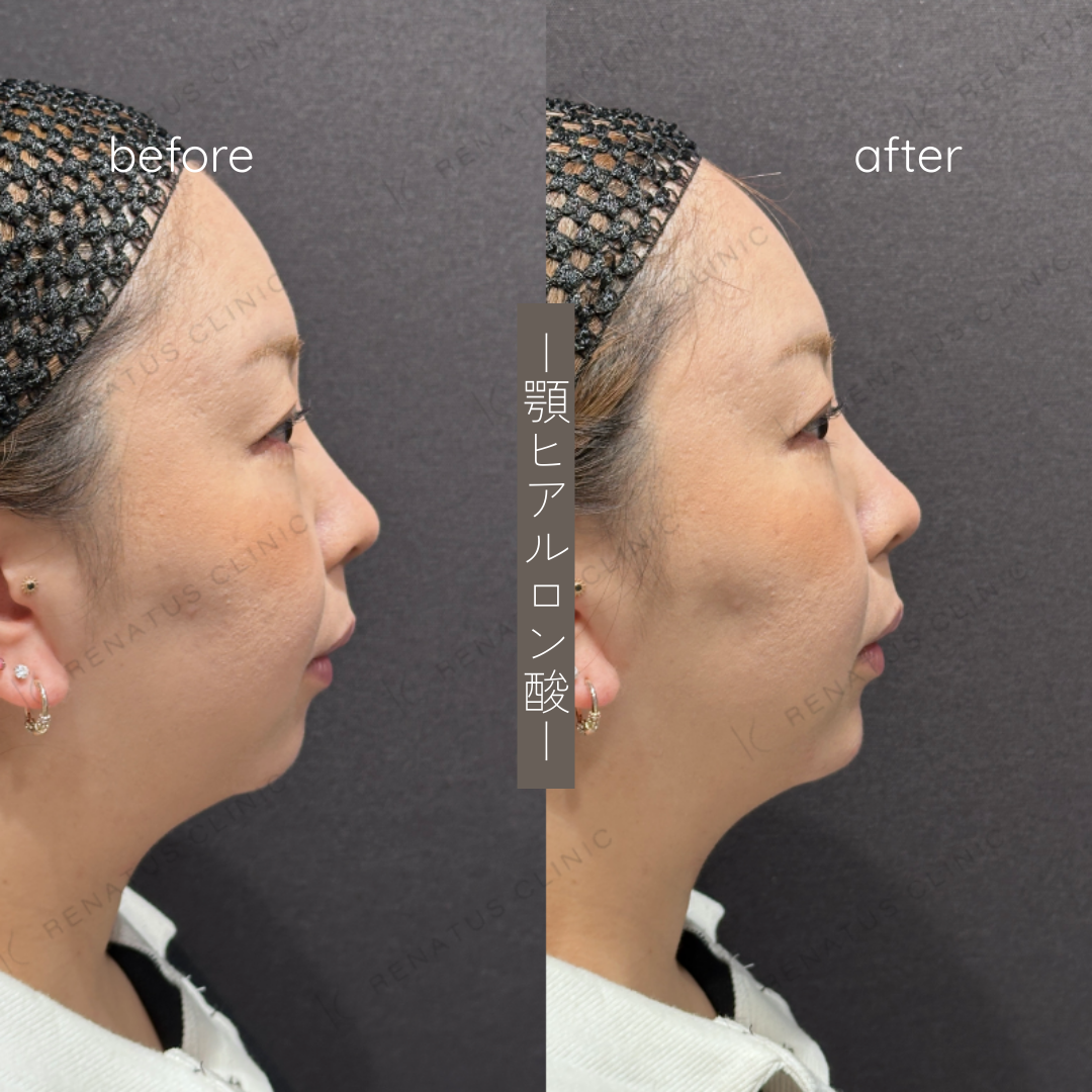 顎ヒアルロン酸ボラックス症例写真 顎ヒアルロン酸ボラックス症例写真