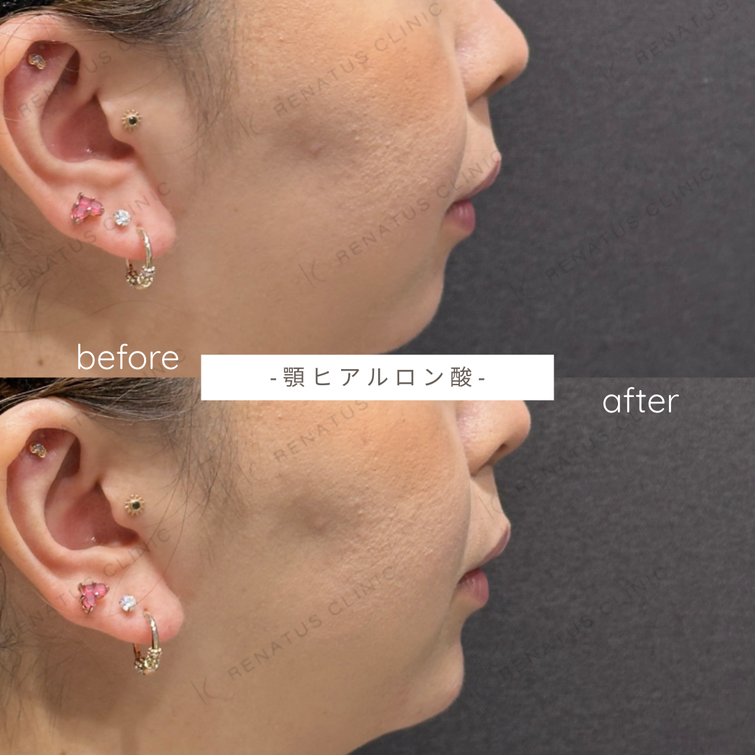 顎ヒアルロン酸ボラックス症例写真 顎ヒアルロン酸ボラックス症例写真