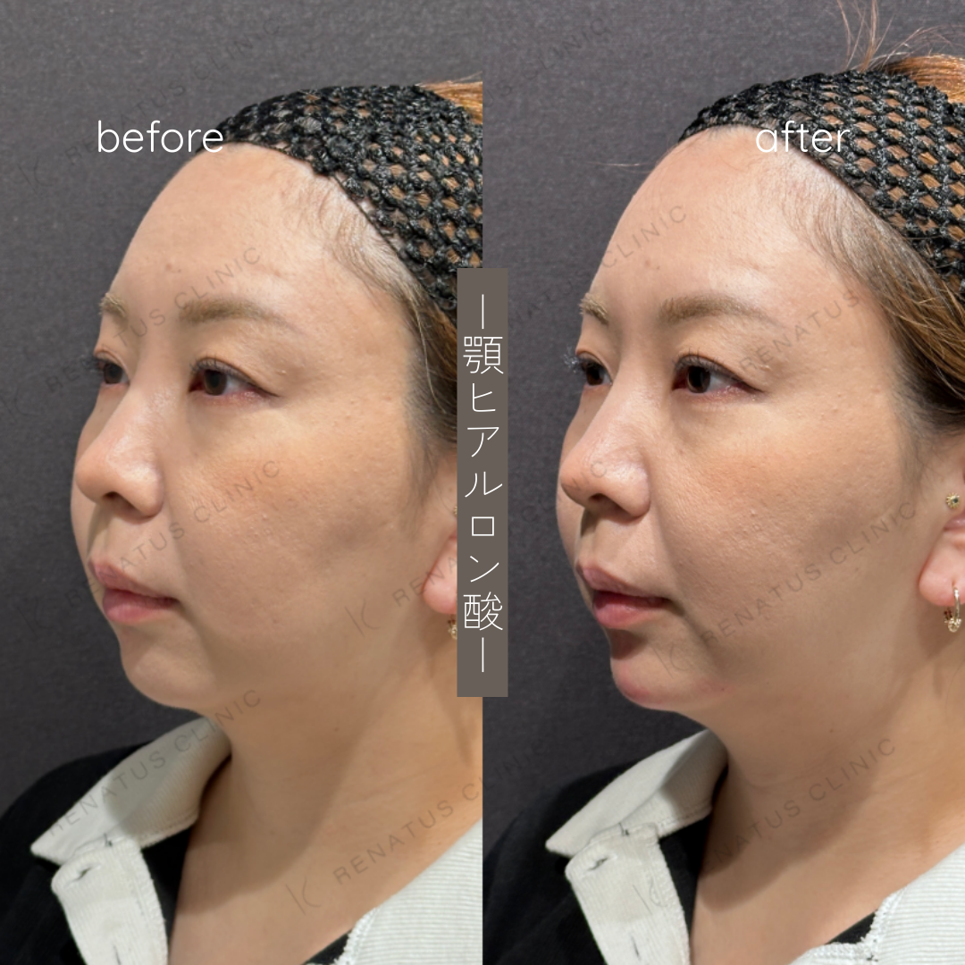 顎ヒアルロン酸ボラックス症例写真 顎ヒアルロン酸ボラックス症例写真