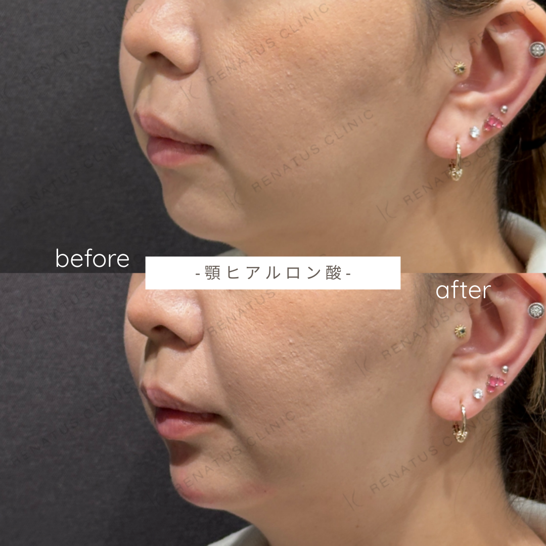 顎ヒアルロン酸ボラックス症例写真 顎ヒアルロン酸ボラックス症例写真