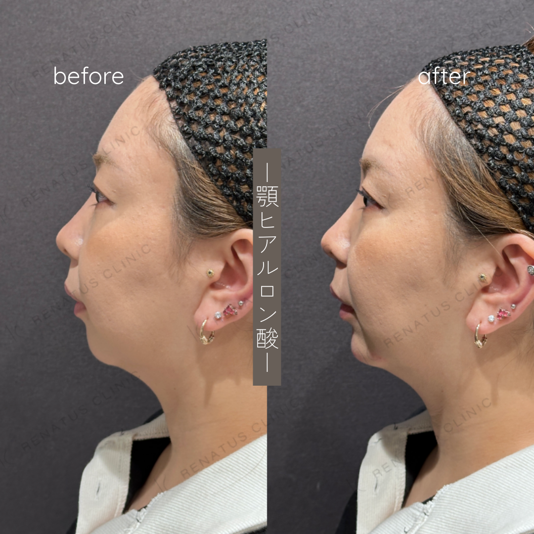 顎ヒアルロン酸ボラックス症例写真 顎ヒアルロン酸ボラックス症例写真