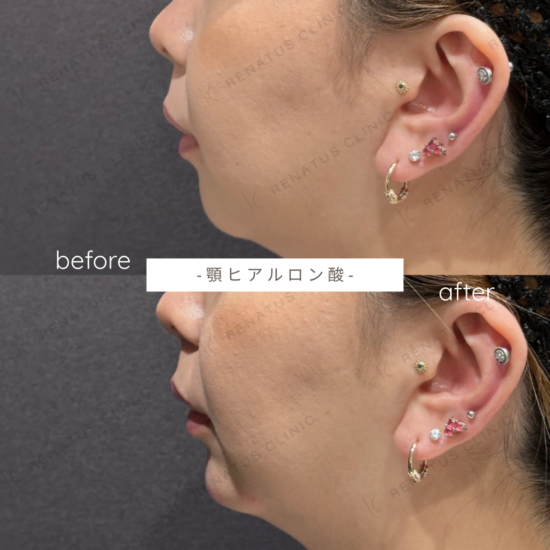 顎ヒアルロン酸ボラックス症例写真 顎ヒアルロン酸ボラックス症例写真