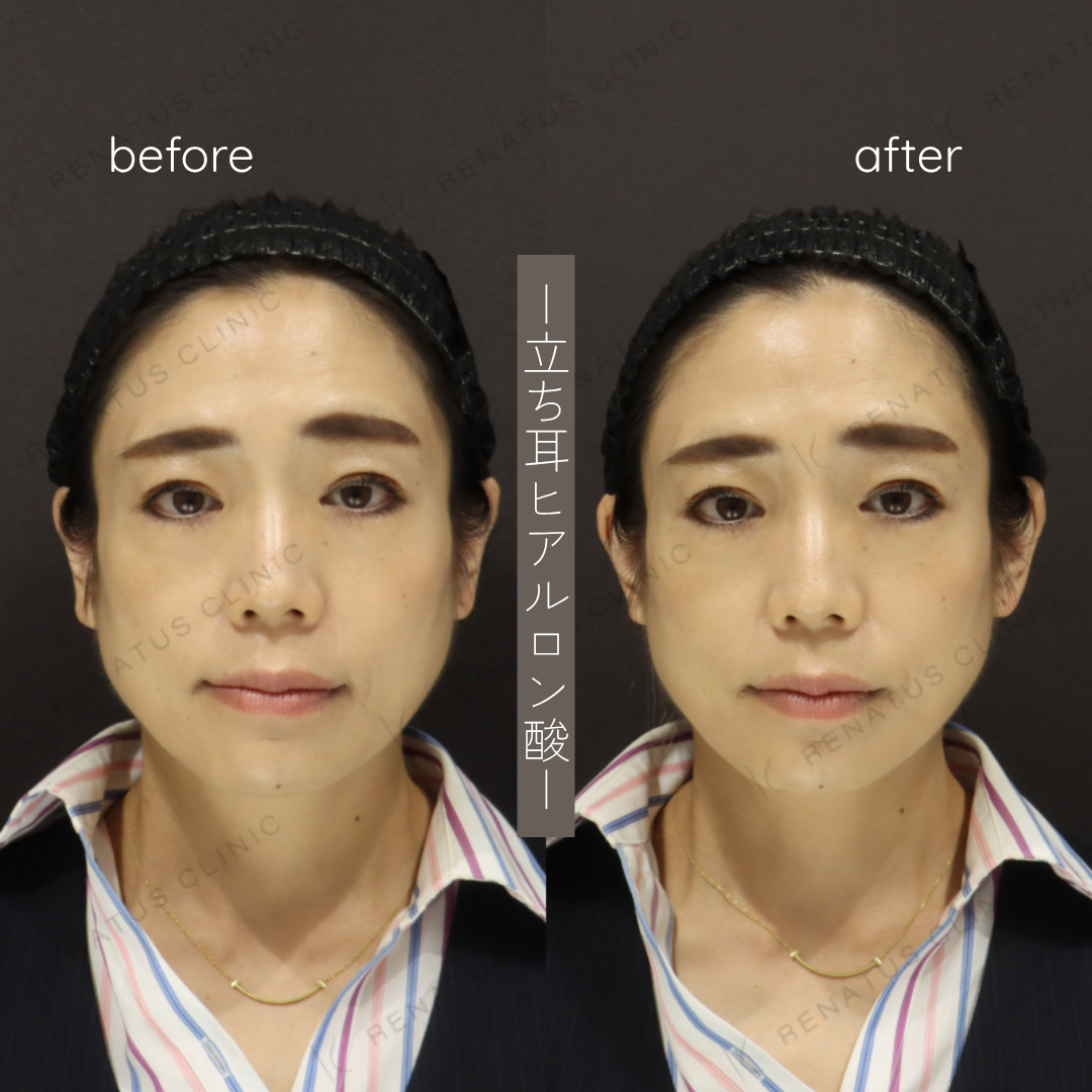 立ち耳ヒアルロン酸ボルベラ症例写真 立ち耳ヒアルロン酸ボルベラ症例写真