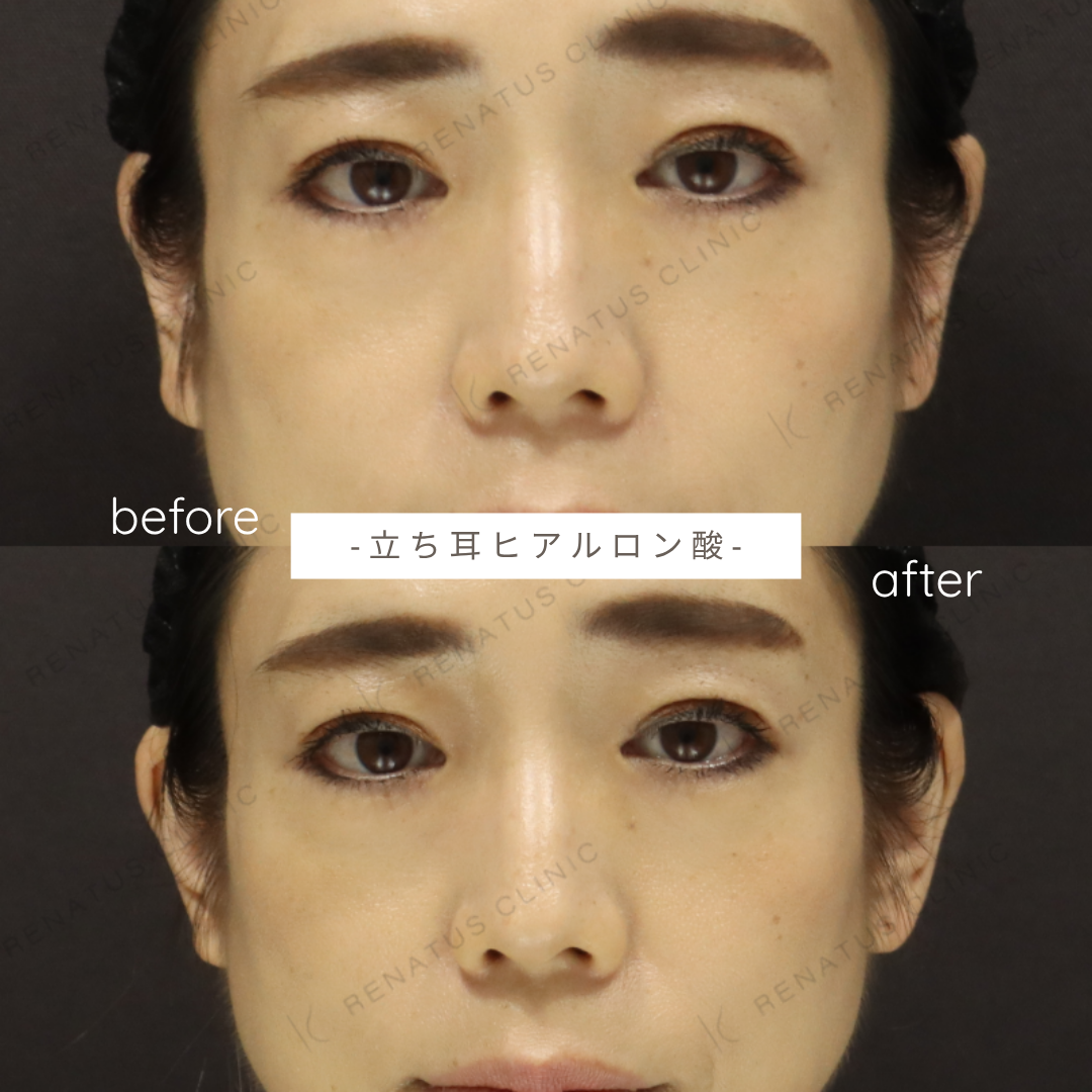 立ち耳ヒアルロン酸ボルベラ症例写真 立ち耳ヒアルロン酸ボルベラ症例写真