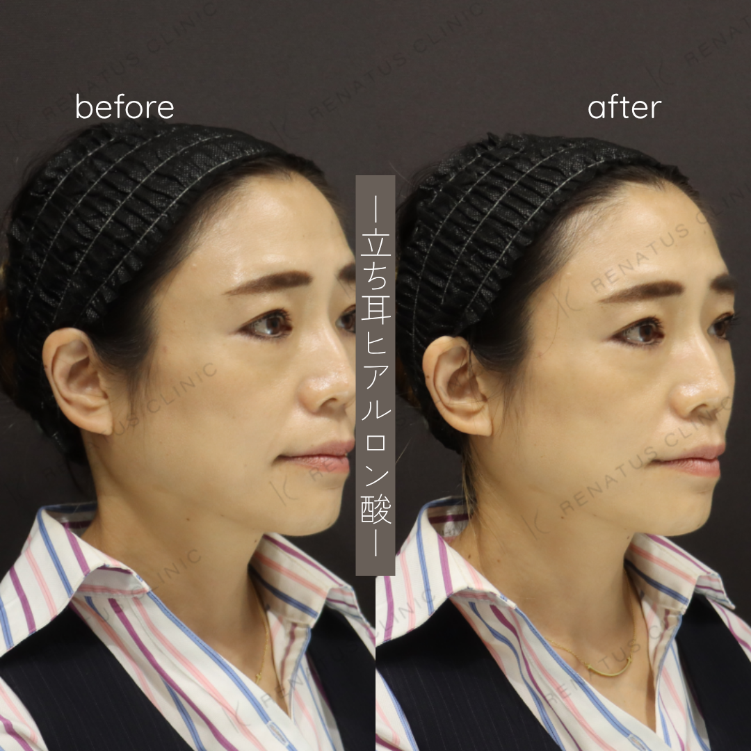 立ち耳ヒアルロン酸ボルベラ症例写真 立ち耳ヒアルロン酸ボルベラ症例写真