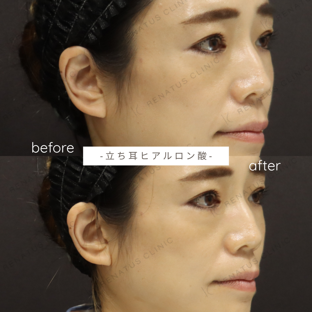 立ち耳ヒアルロン酸ボルベラ症例写真 立ち耳ヒアルロン酸ボルベラ症例写真