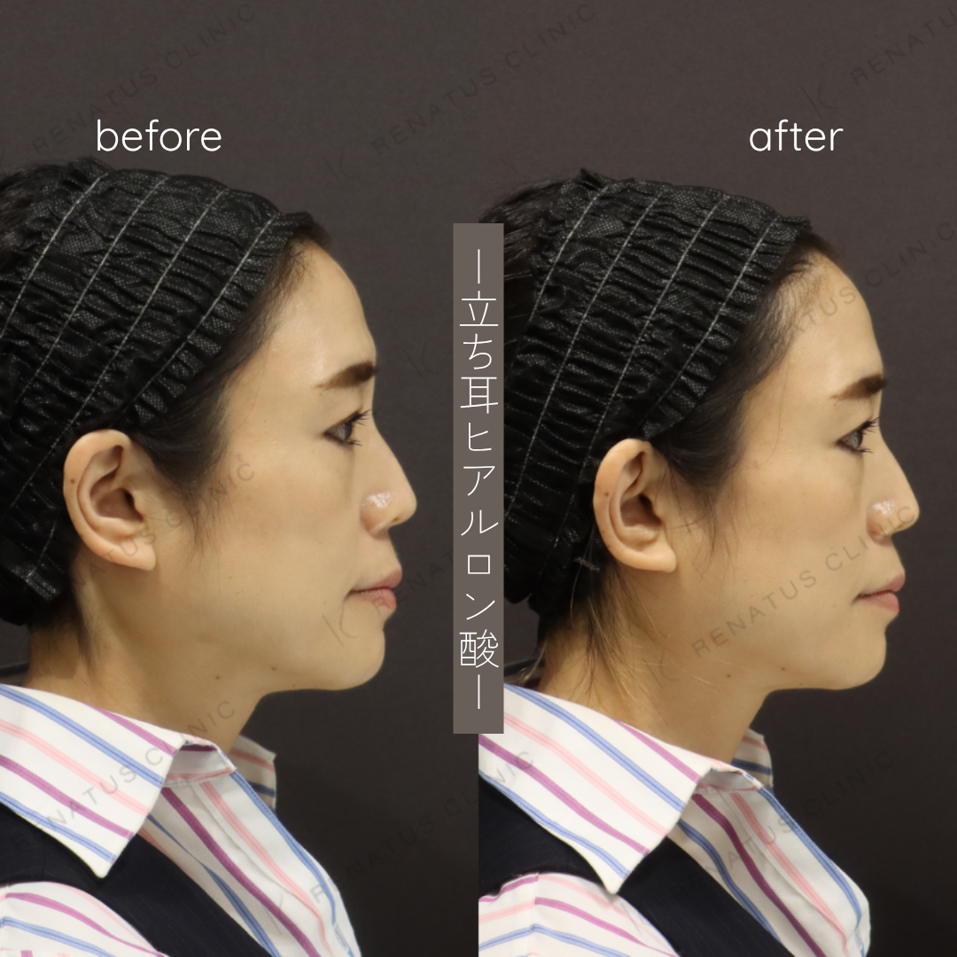 立ち耳ヒアルロン酸ボルベラ症例写真 立ち耳ヒアルロン酸ボルベラ症例写真