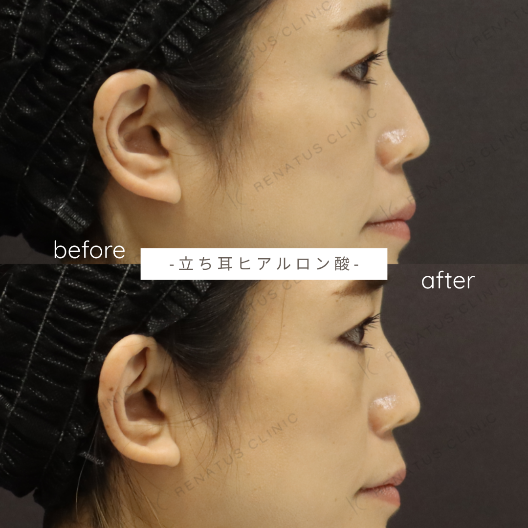 立ち耳ヒアルロン酸ボルベラ症例写真 立ち耳ヒアルロン酸ボルベラ症例写真