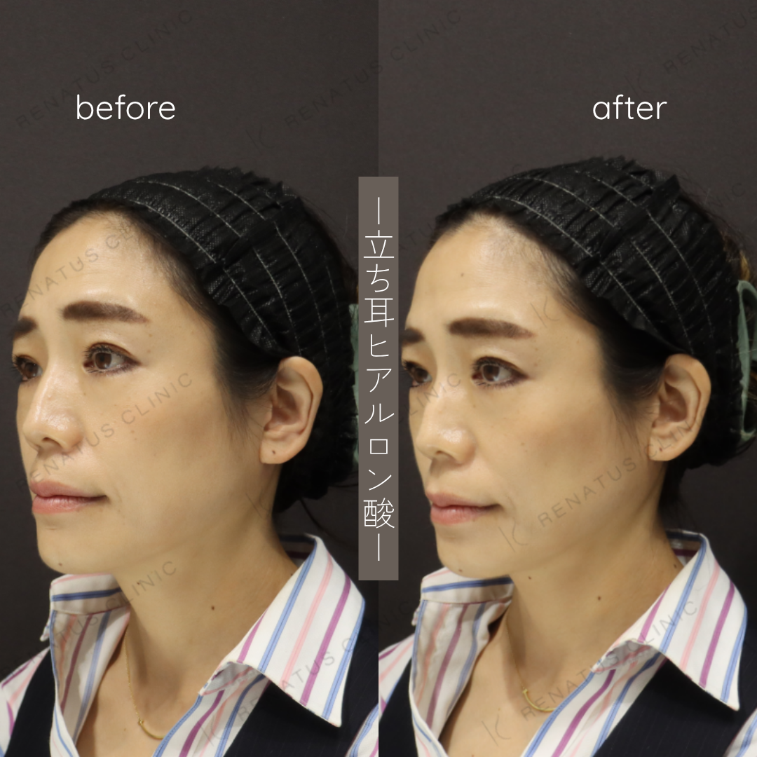 立ち耳ヒアルロン酸ボルベラ症例写真 立ち耳ヒアルロン酸ボルベラ症例写真