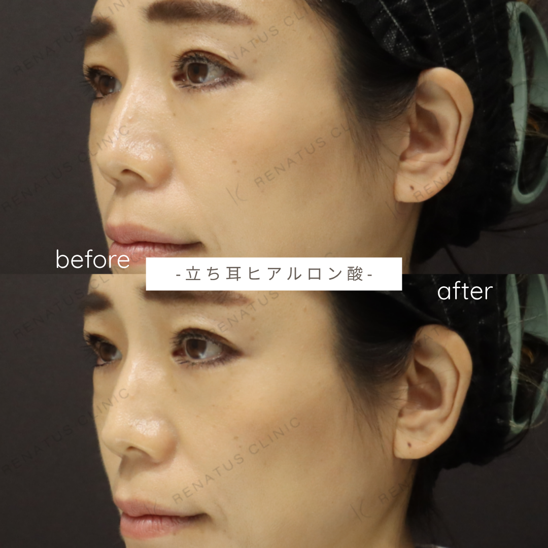 立ち耳ヒアルロン酸ボルベラ症例写真 立ち耳ヒアルロン酸ボルベラ症例写真