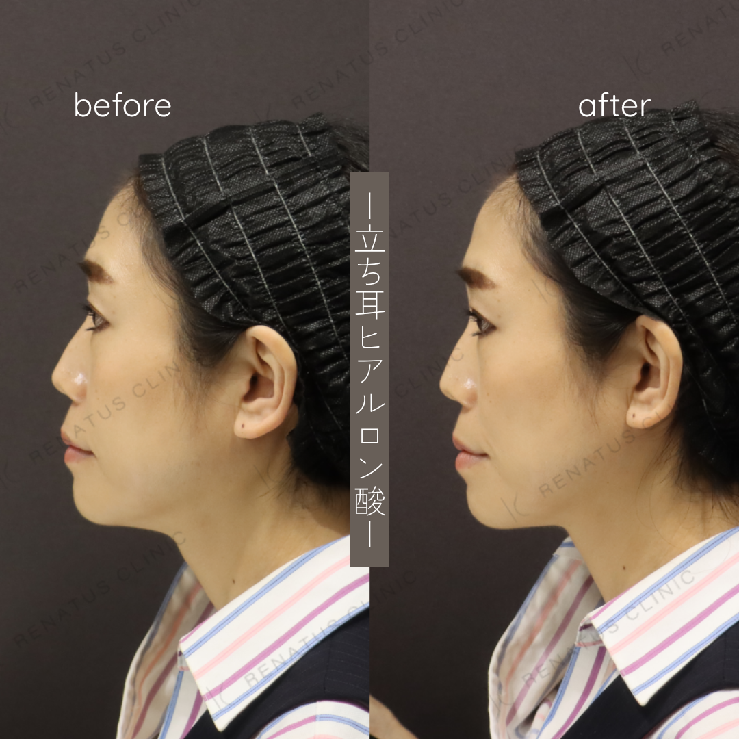 立ち耳ヒアルロン酸ボルベラ症例写真 立ち耳ヒアルロン酸ボルベラ症例写真