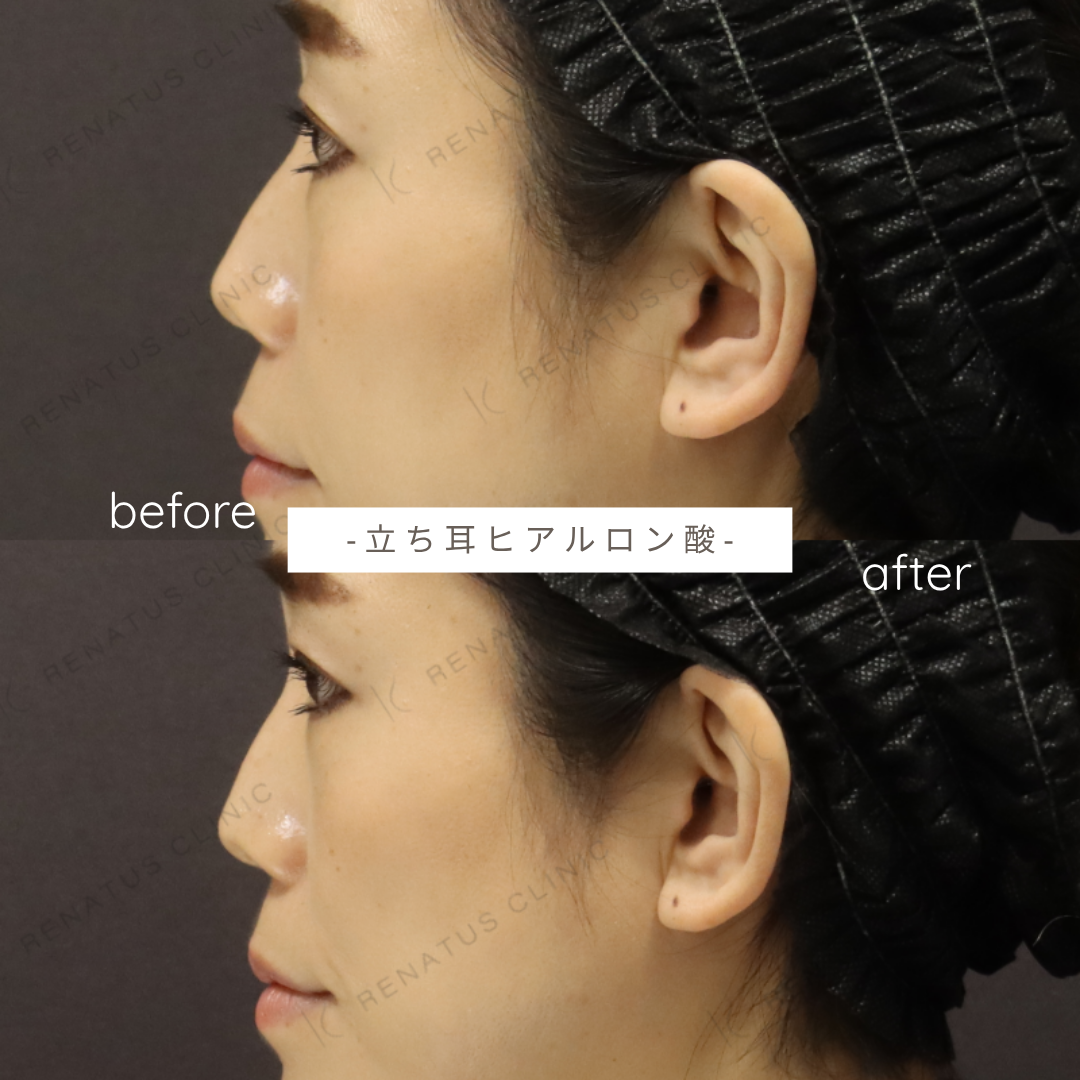 立ち耳ヒアルロン酸ボルベラ症例写真 立ち耳ヒアルロン酸ボルベラ症例写真