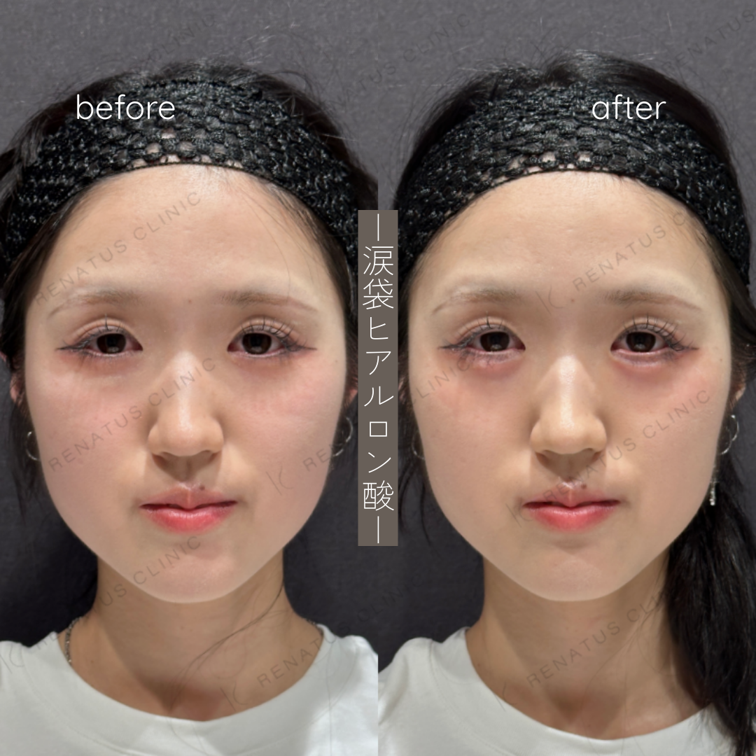 涙袋ヒアルロン酸ボルベラ症例写真 涙袋ヒアルロン酸ボルベラ症例写真