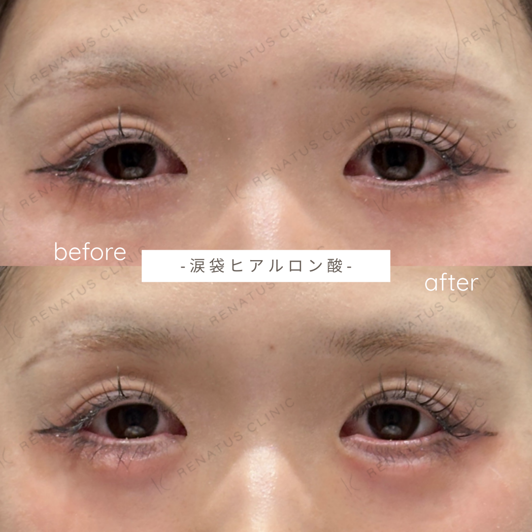 涙袋ヒアルロン酸ボルベラ症例写真 涙袋ヒアルロン酸ボルベラ症例写真