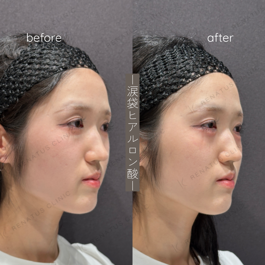 涙袋ヒアルロン酸ボルベラ症例写真 涙袋ヒアルロン酸ボルベラ症例写真