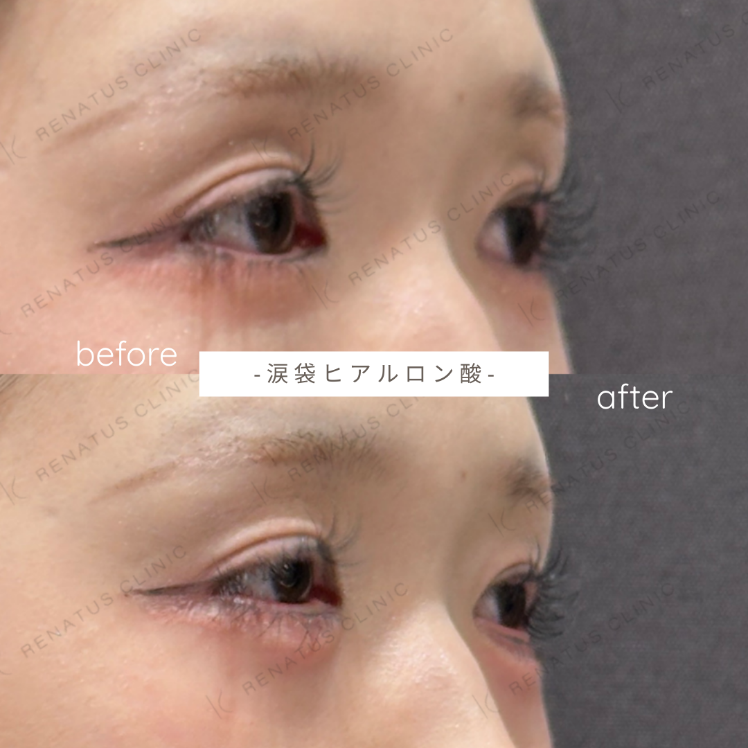 涙袋ヒアルロン酸ボルベラ症例写真 涙袋ヒアルロン酸ボルベラ症例写真