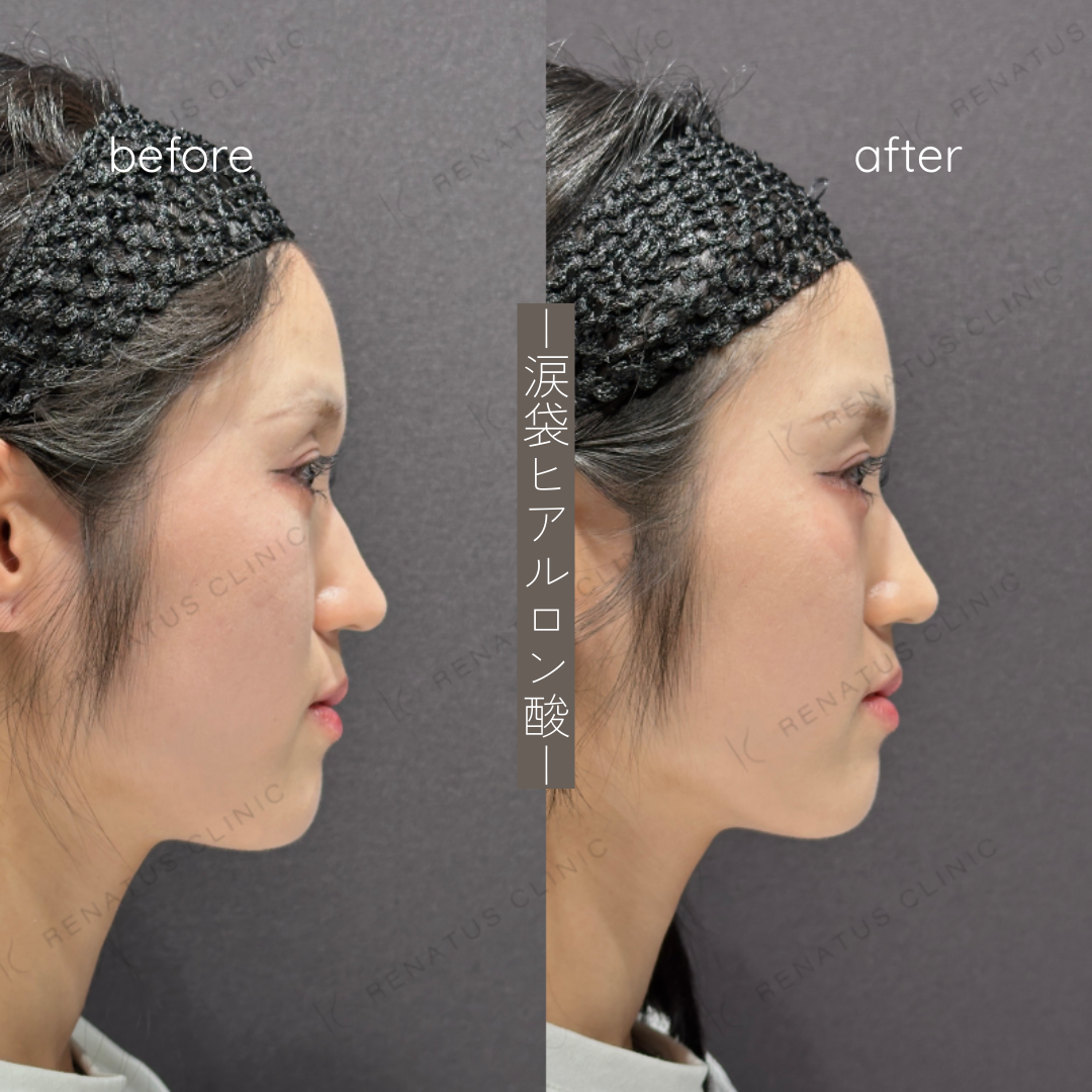 涙袋ヒアルロン酸ボルベラ症例写真 涙袋ヒアルロン酸ボルベラ症例写真