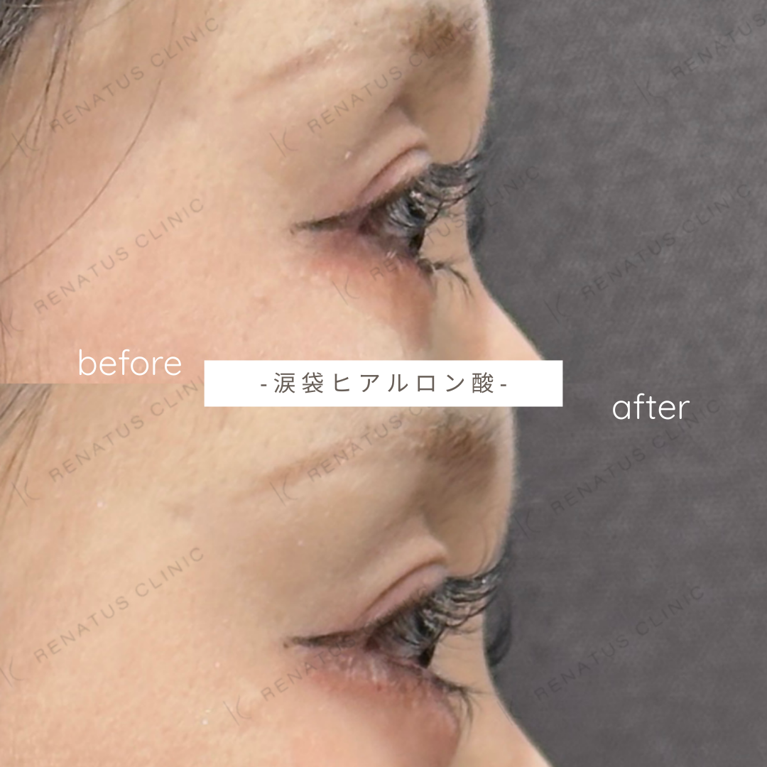 涙袋ヒアルロン酸ボルベラ症例写真 涙袋ヒアルロン酸ボルベラ症例写真