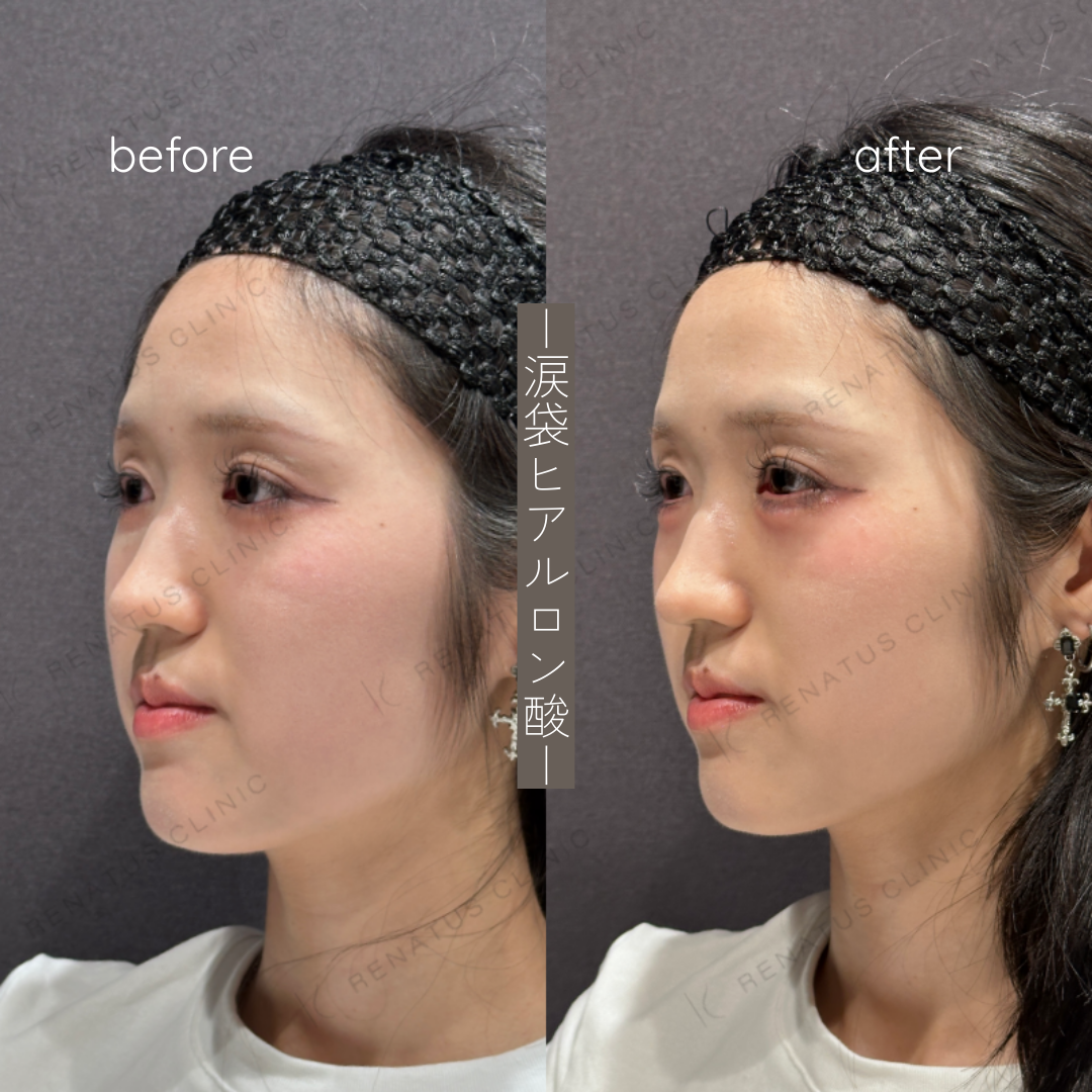 涙袋ヒアルロン酸ボルベラ症例写真 涙袋ヒアルロン酸ボルベラ症例写真