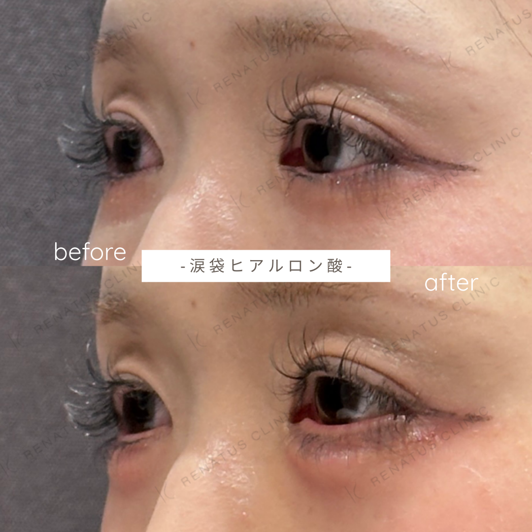 涙袋ヒアルロン酸ボルベラ症例写真 涙袋ヒアルロン酸ボルベラ症例写真