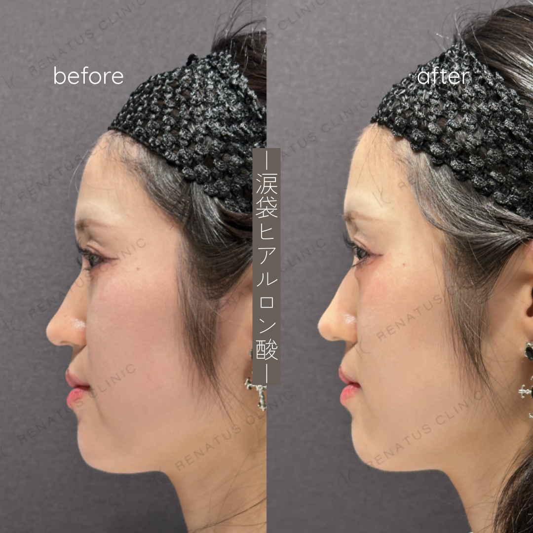 涙袋ヒアルロン酸ボルベラ症例写真 涙袋ヒアルロン酸ボルベラ症例写真