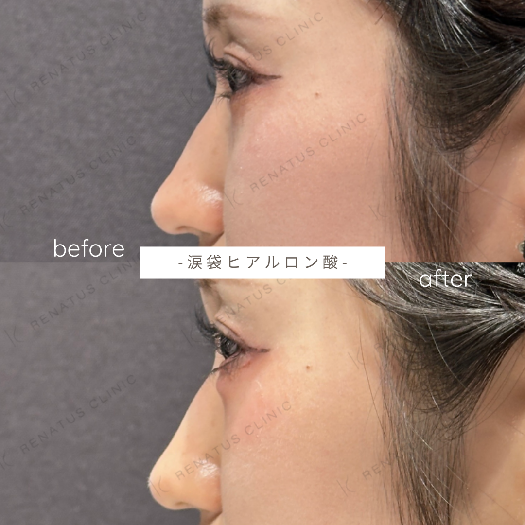 涙袋ヒアルロン酸ボルベラ症例写真 涙袋ヒアルロン酸ボルベラ症例写真